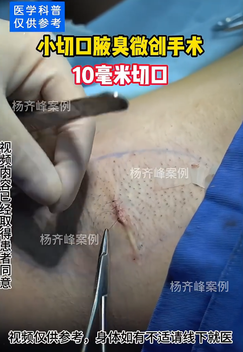 现在最先进的腋臭手术 现在最先进的腋臭手术