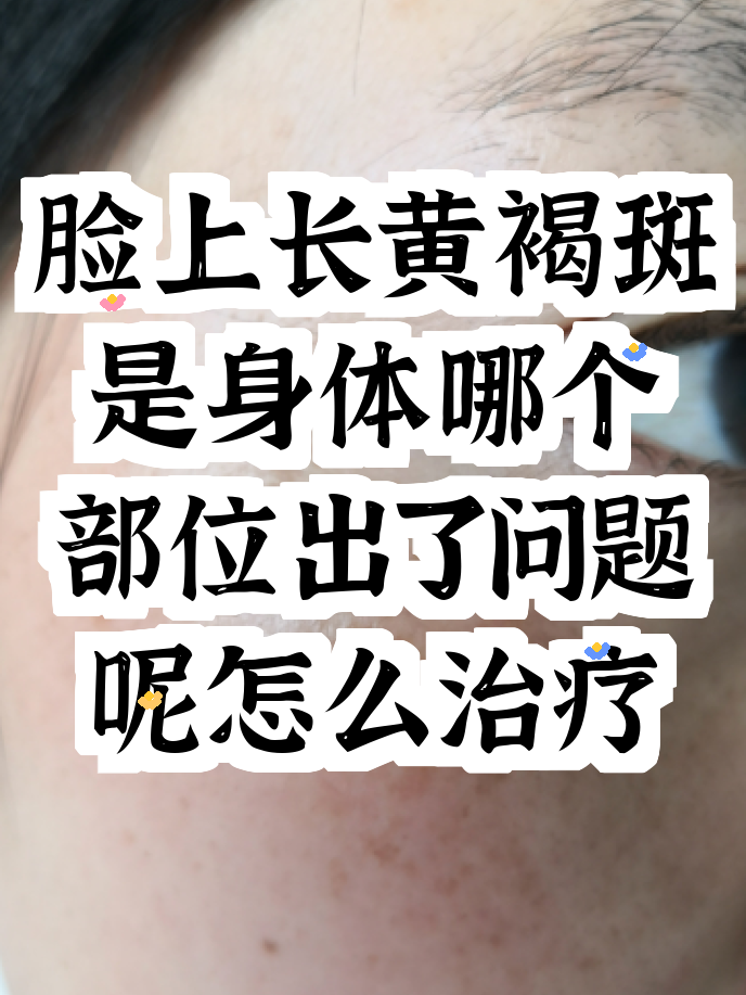 脸上长黄褐斑看什么科 脸上长黄褐斑看什么科