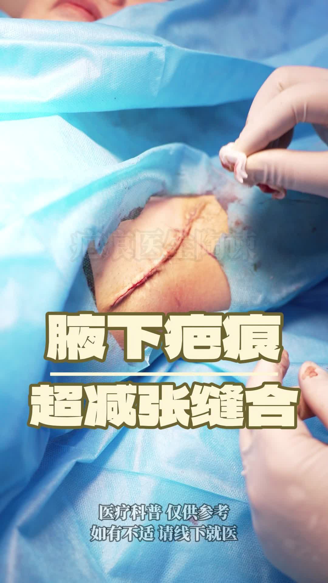 狐臭手术有效果吗