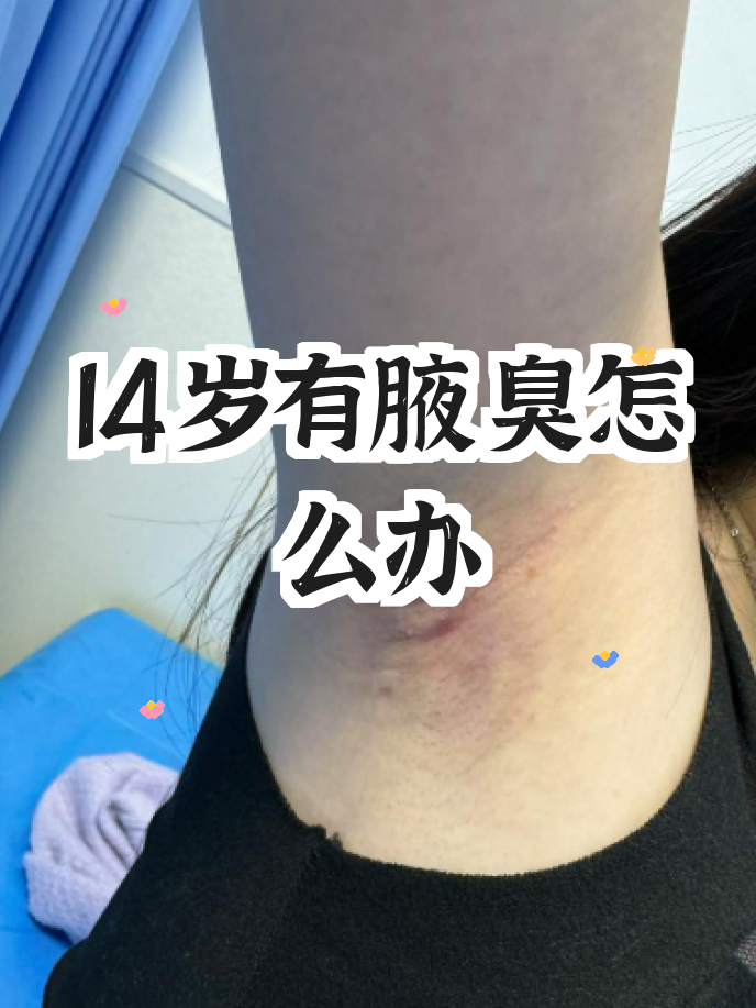 有狐臭的人腋下图片