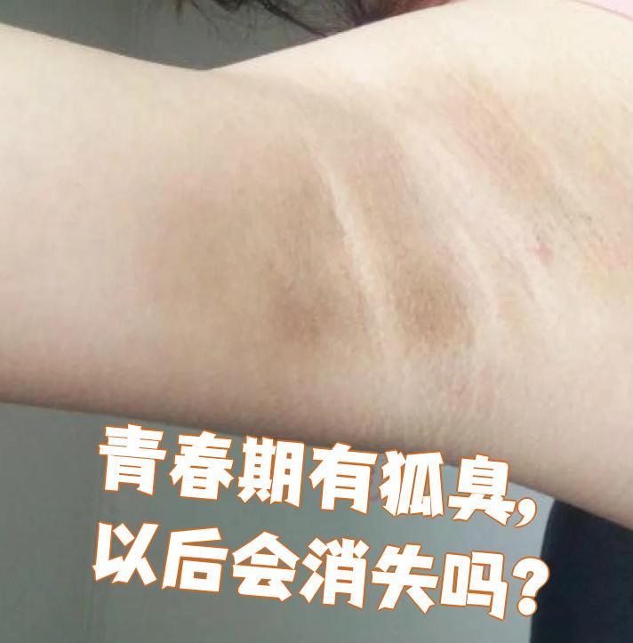 狐臭的人有什么特征