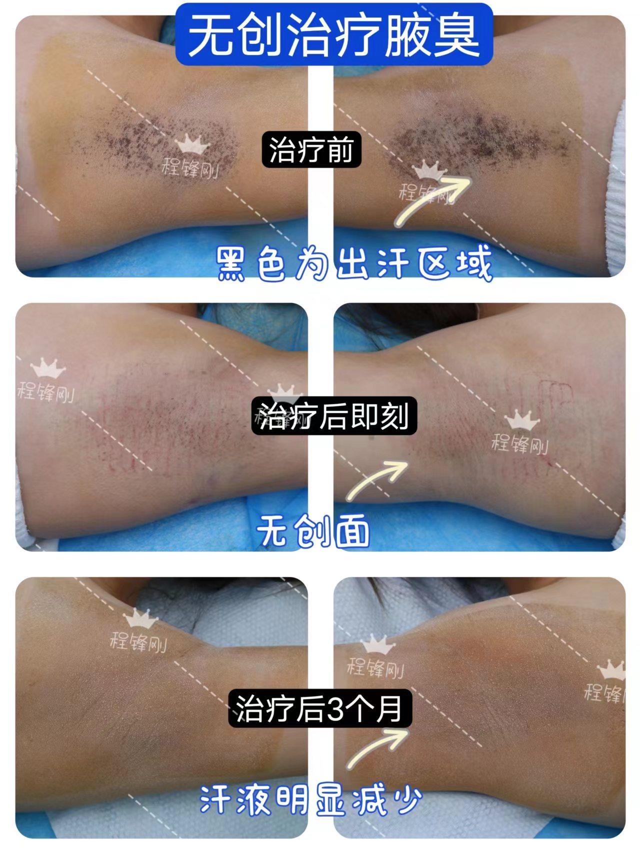 做腋臭手术可以用医保吗 做腋臭手术可以用医保吗