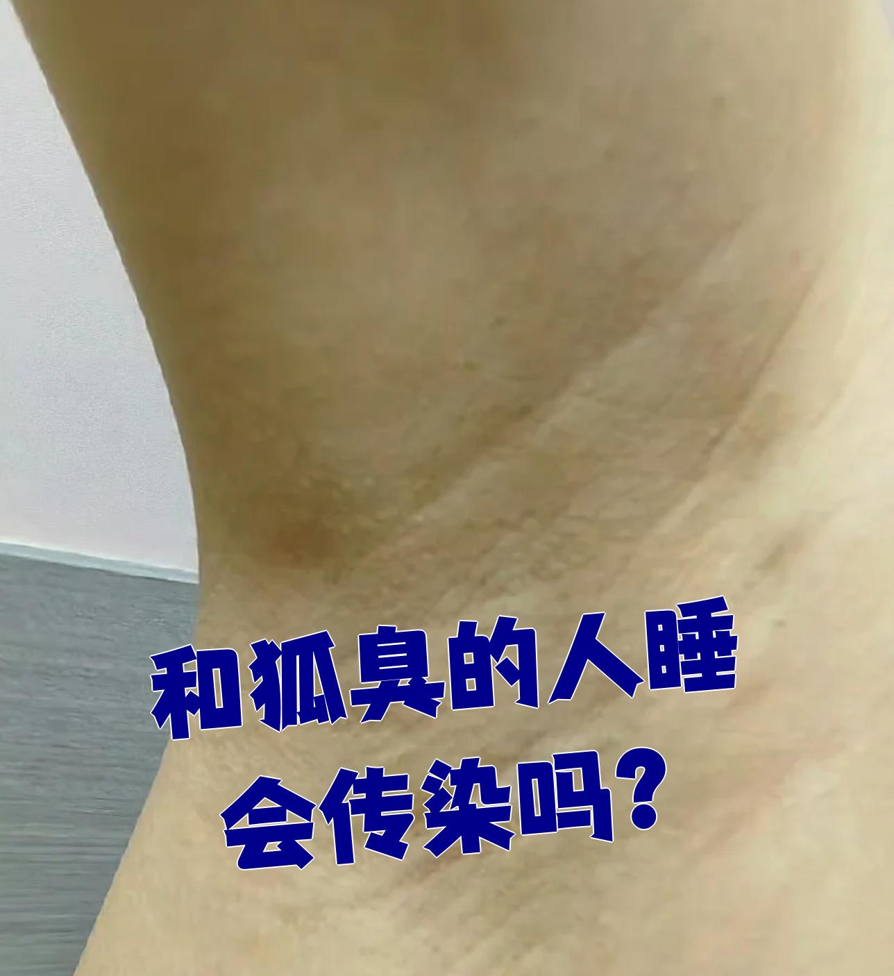 狐臭和正常人腋窝有区别吗 狐臭和正常人腋窝有区别吗