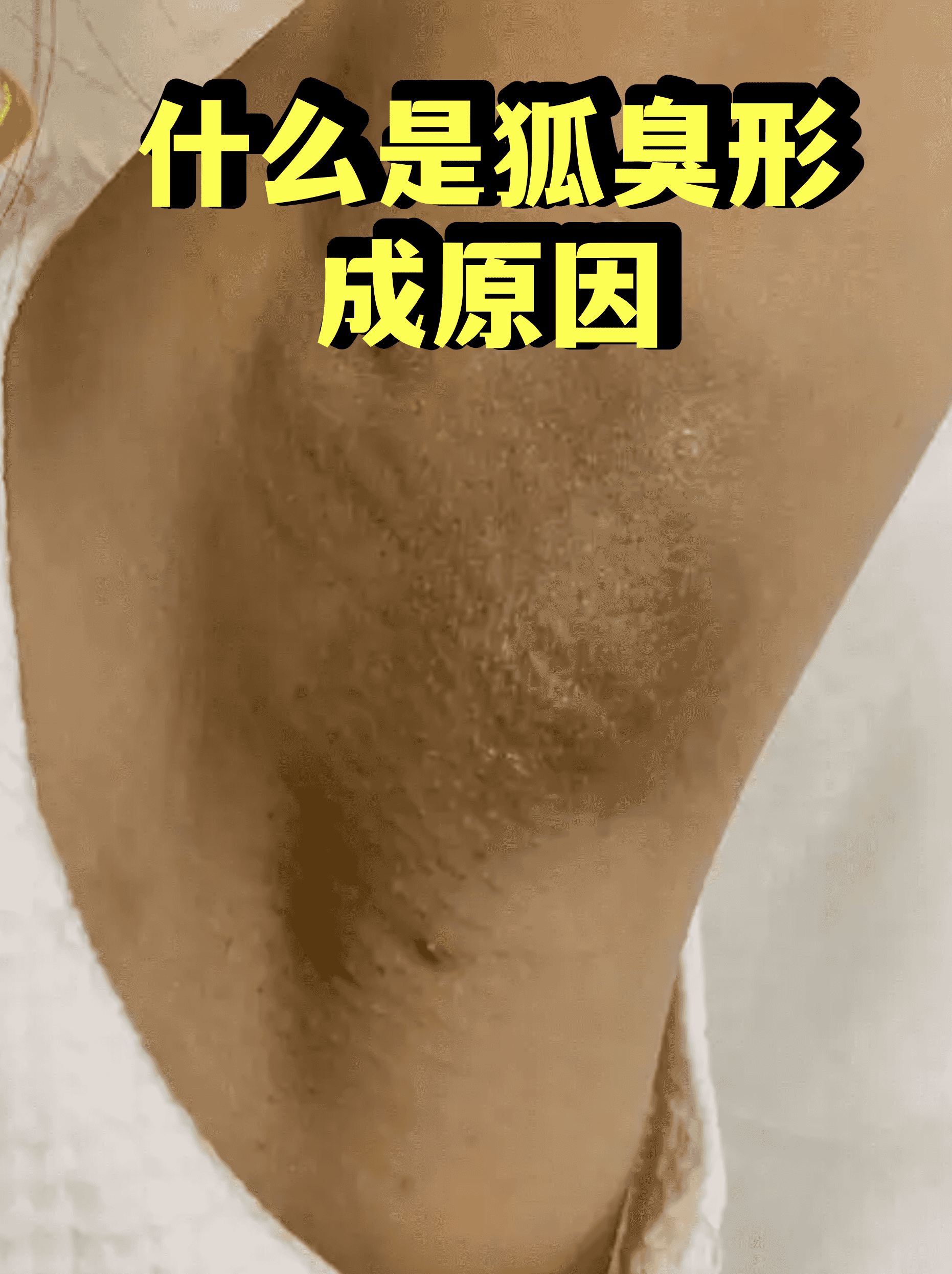 腋臭和狐臭的气味是啥样的 腋臭和狐臭的气味是啥样的