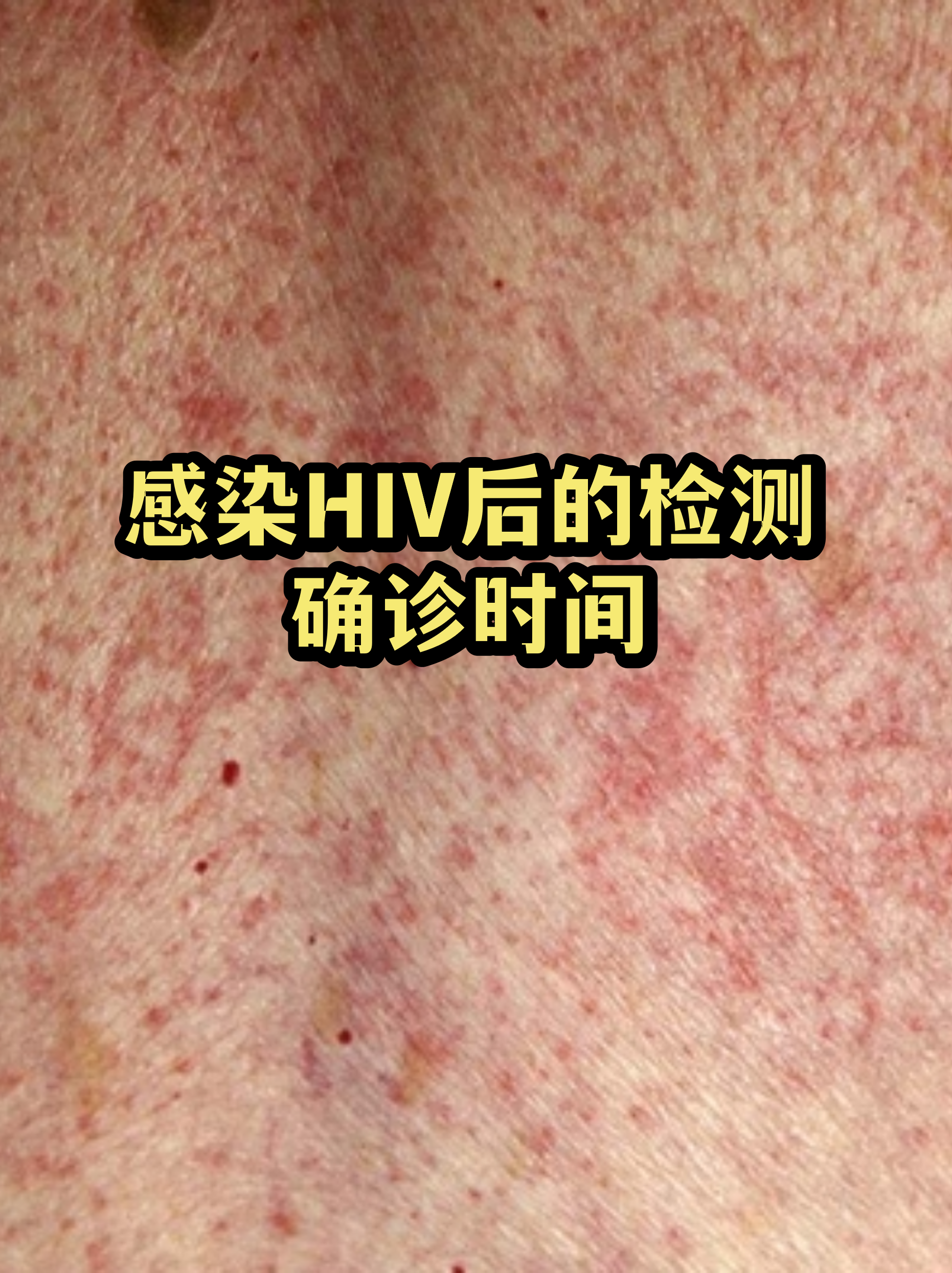 hiv第四代多久能检测出来 hiv第四代多久能检测出来