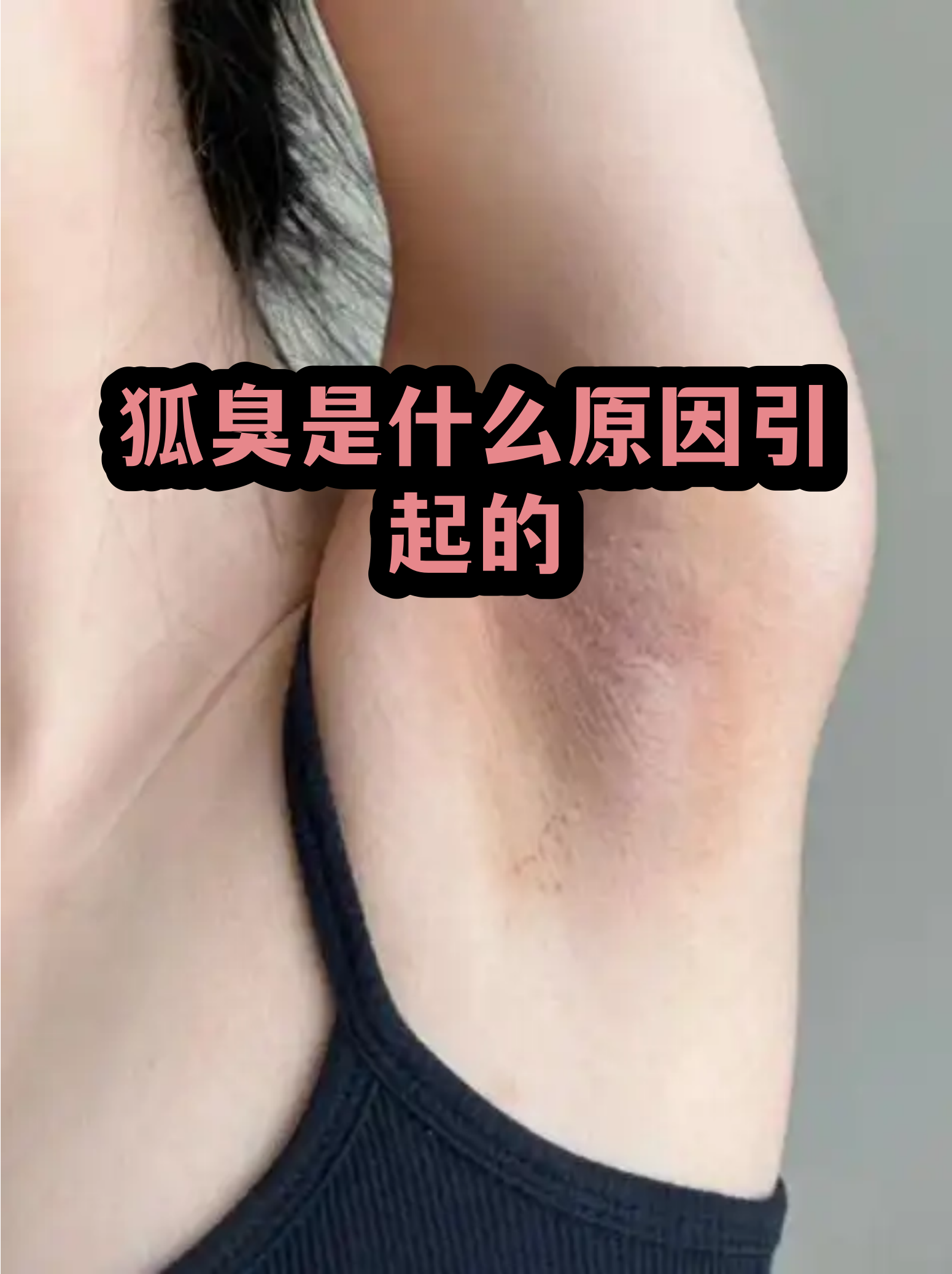 狐臭除了遗传还有其他途径患上吗(狐臭除了遗传还有其他途径患上吗图片)