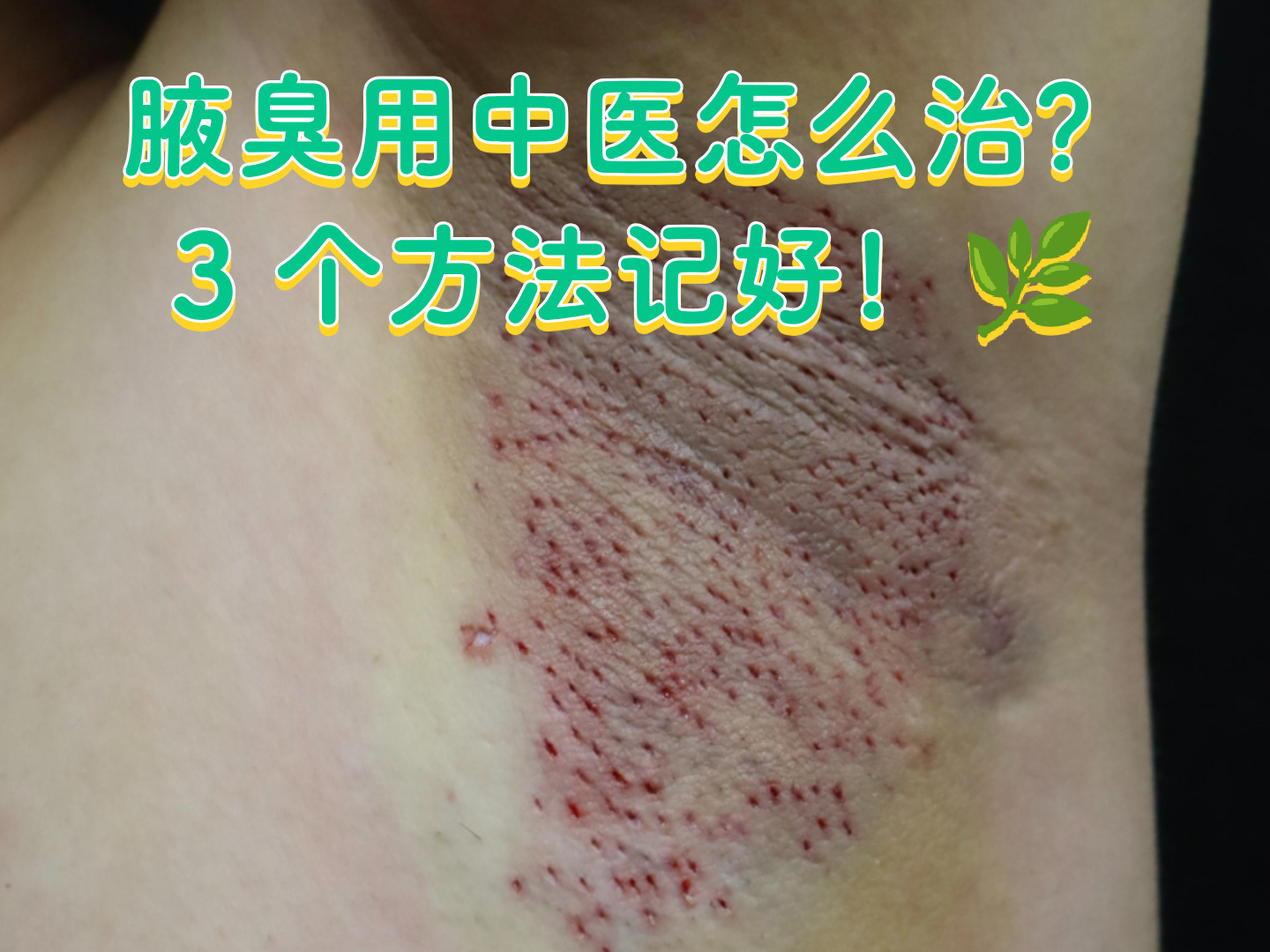 天生狐臭能治好吗(天生狐臭怎么解决根除) 天生狐臭能治好吗(天生狐臭怎么解决根除)
