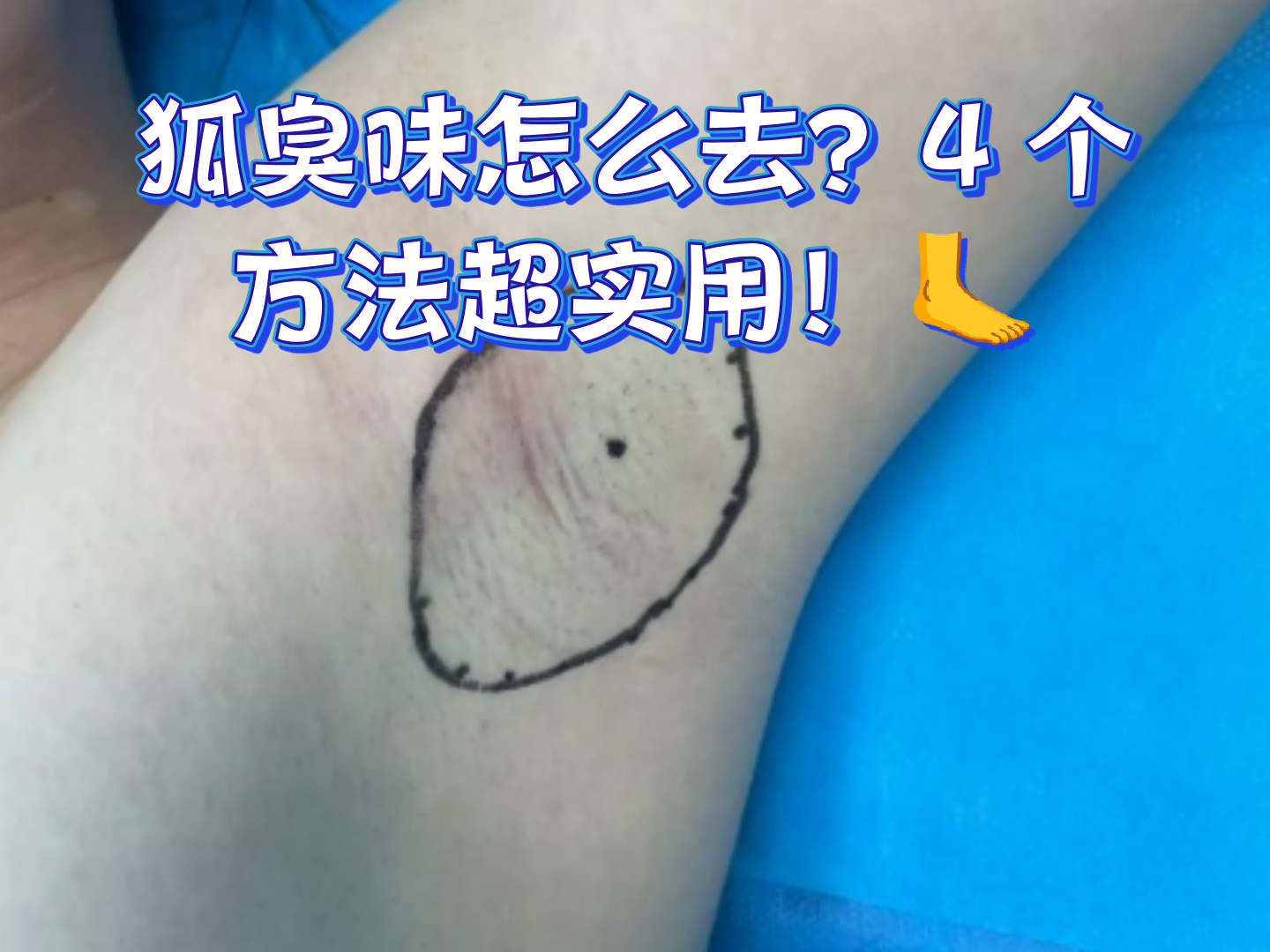 狐臭如何去除更好(狐臭如何去除更好一点)