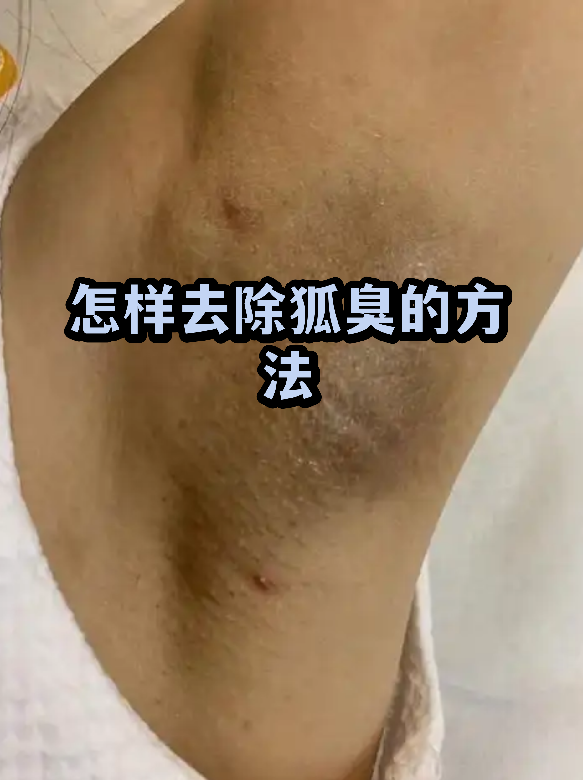 腋下脱毛会引起狐臭吗(脱腋下的毛会引起狐臭吗)