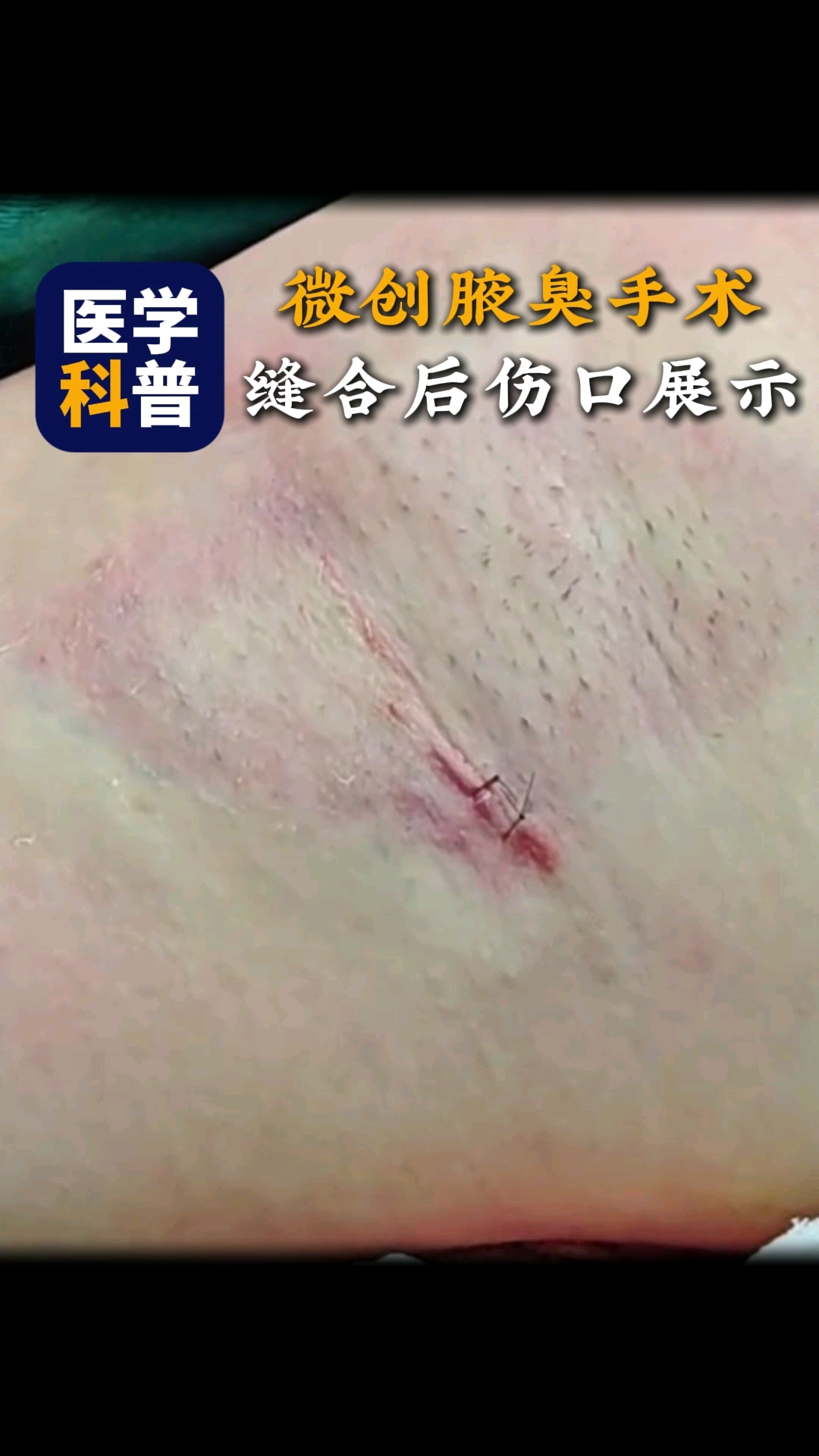 狐臭手术后多久可以洗澡(狐臭手术后多久可以剧烈运动)