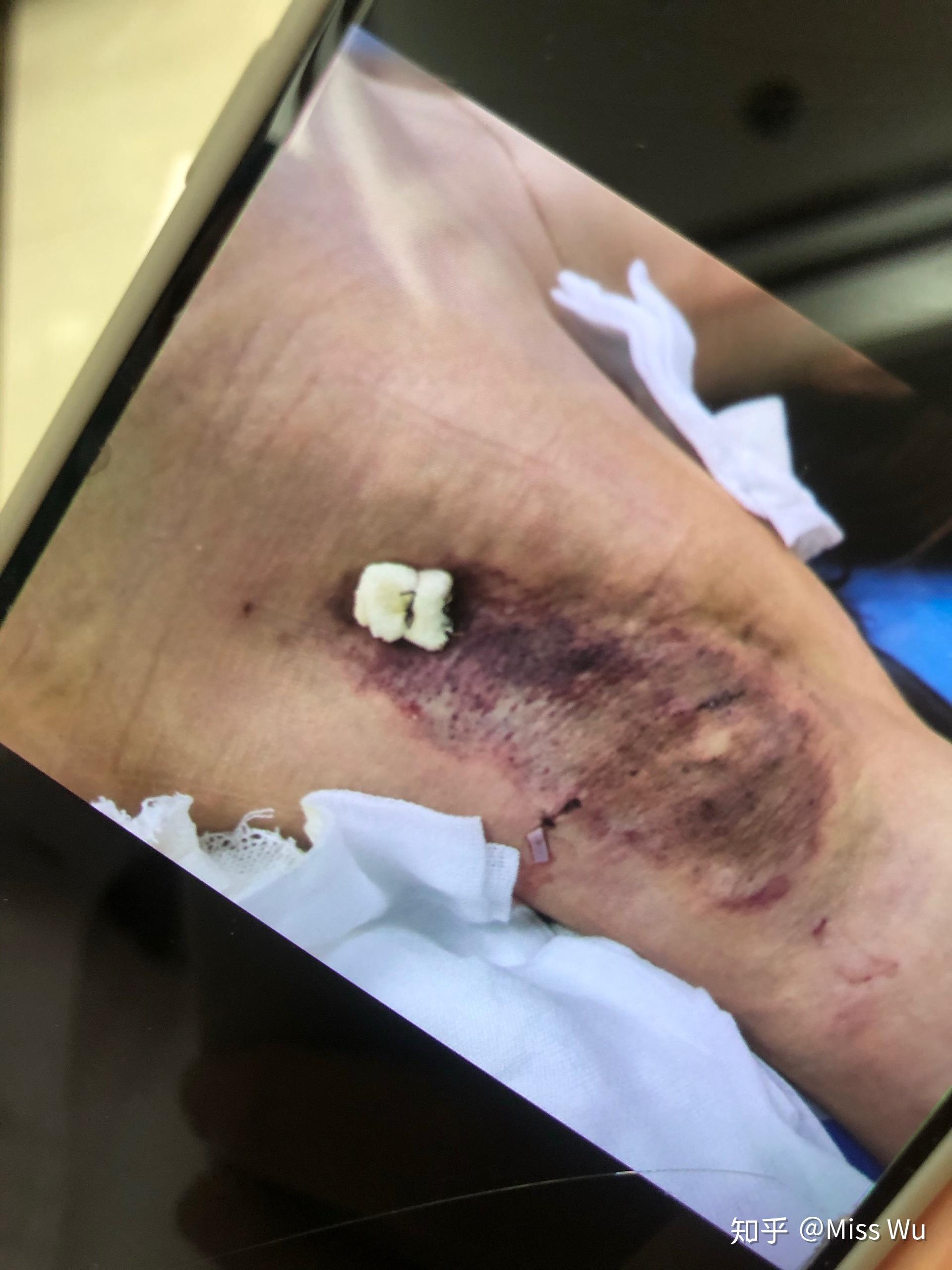 狐臭手术后多久可以洗澡(狐臭手术后多久可以剧烈运动) 狐臭手术后多久可以洗澡(狐臭手术后多久可以剧烈运动)