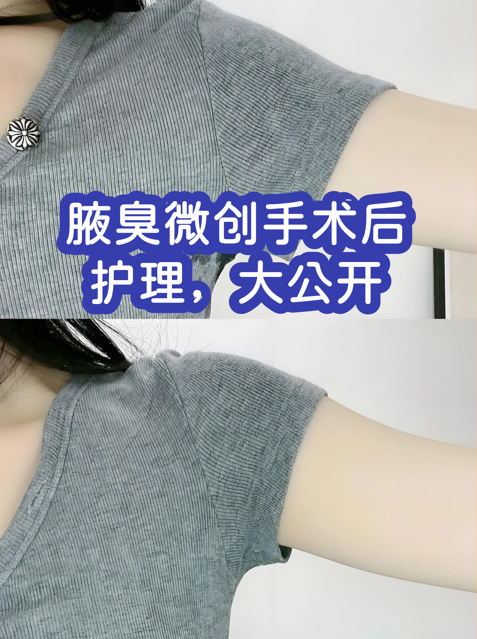 狐臭可以做手术根除吗(狐臭可以做手术根除吗,会复发吗)