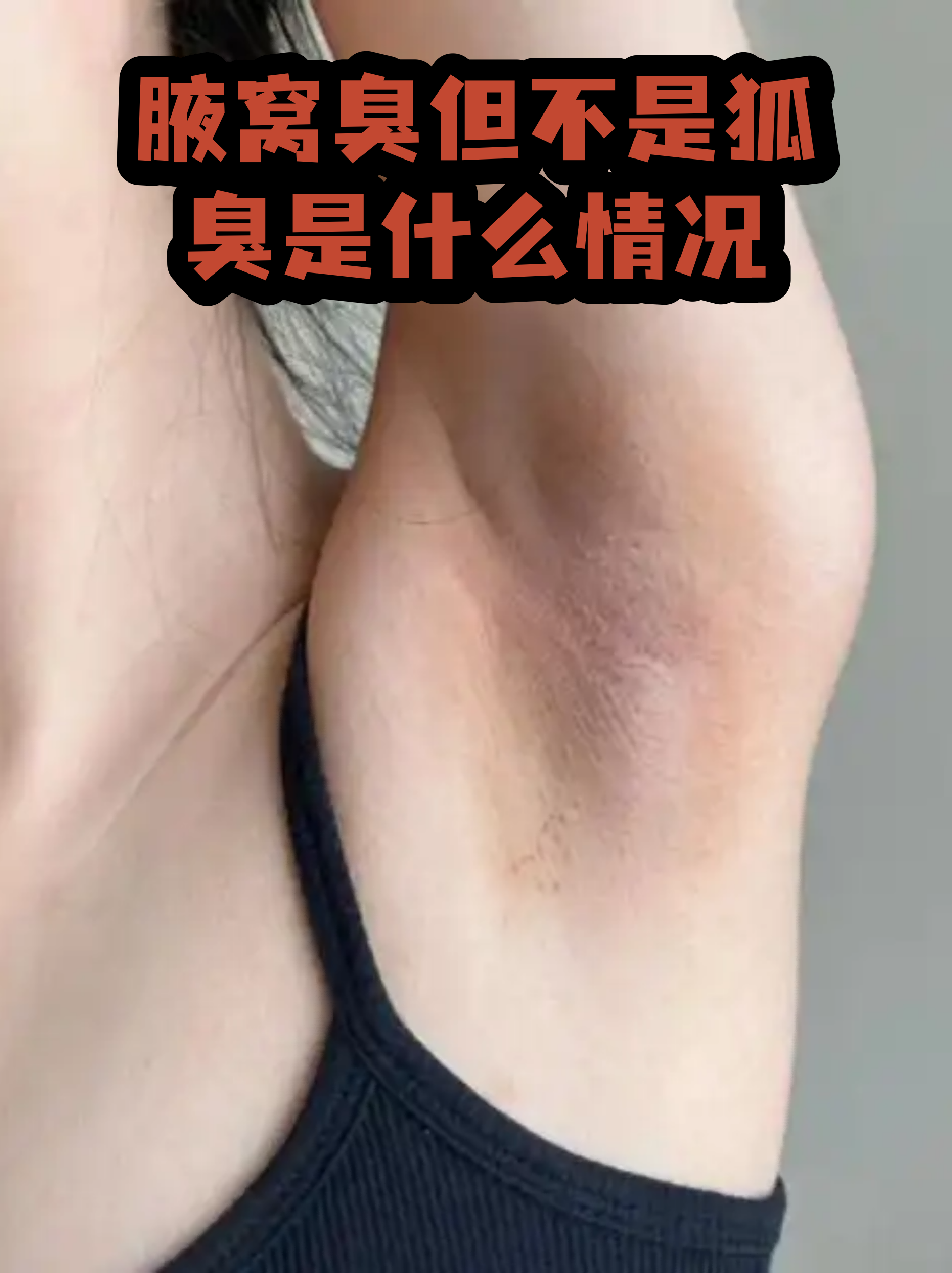 狐臭的腋下图片(狐臭是怎么形成的腋下有味)