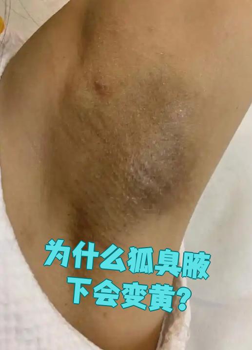 狐臭和正常人腋窝图片对比(狐臭和正常人腋窝图片对比大全)