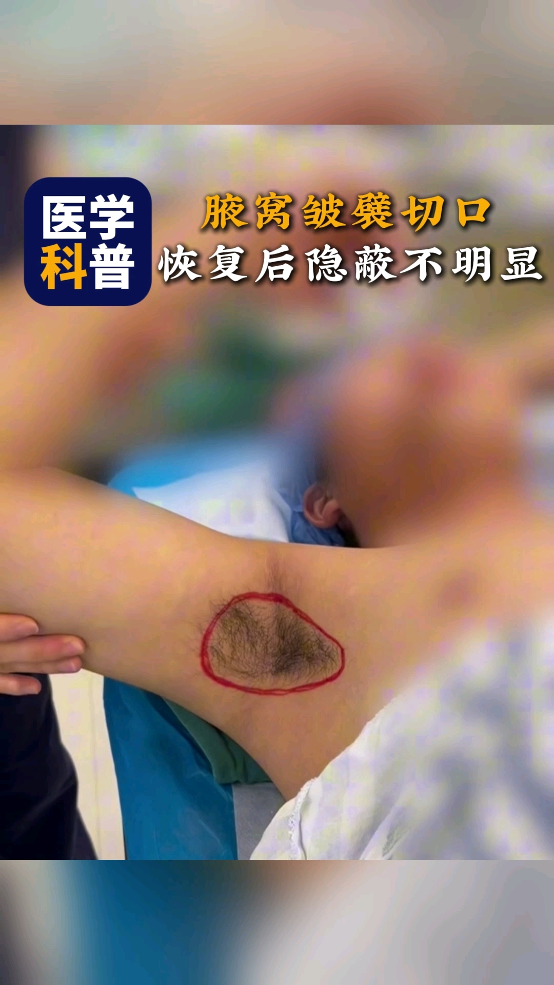 腋臭手术后不用药能自愈吗(腋臭手术后可以更快的恢复吗)