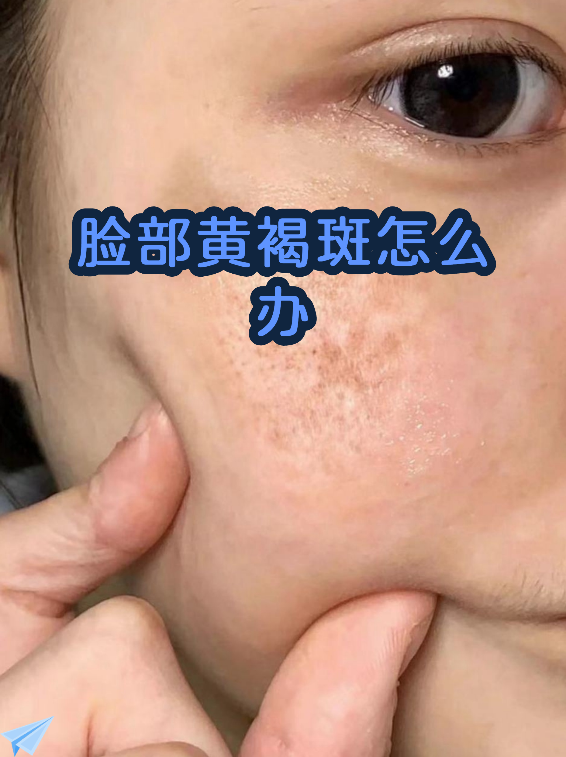 脸上长黄褐斑要查哪项检查(脸上长黄褐斑可以去查代谢功能吗) 脸上长黄褐斑要查哪项检查(脸上长黄褐斑可以去查代谢功能吗)