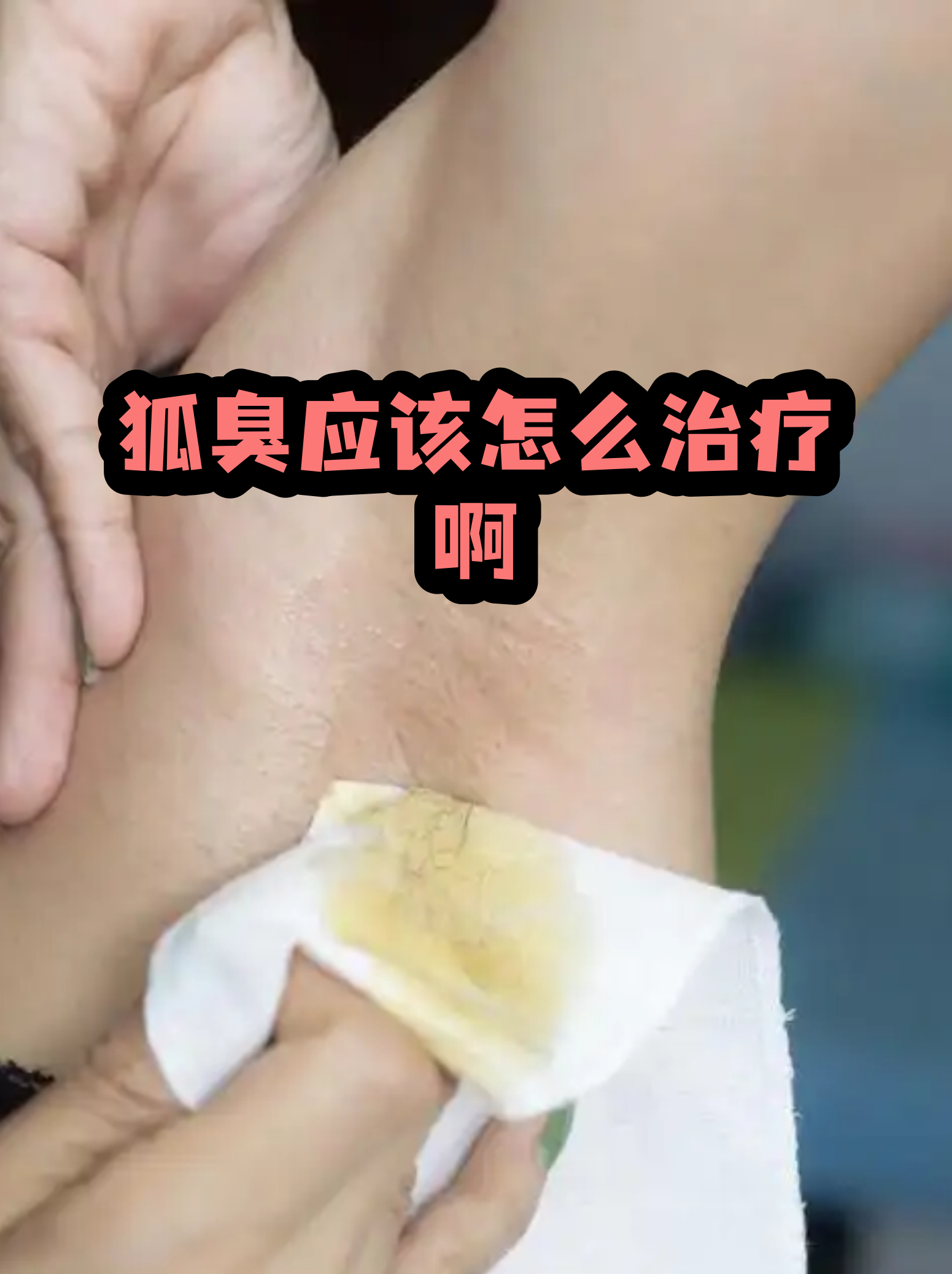 狐臭民间治疗方法(狐臭治疗方法和费用) 狐臭民间治疗方法(狐臭治疗方法和费用)