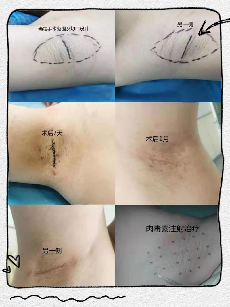 40岁还有必要做腋臭手术吗(做狐臭手术最佳时间是什么时候)