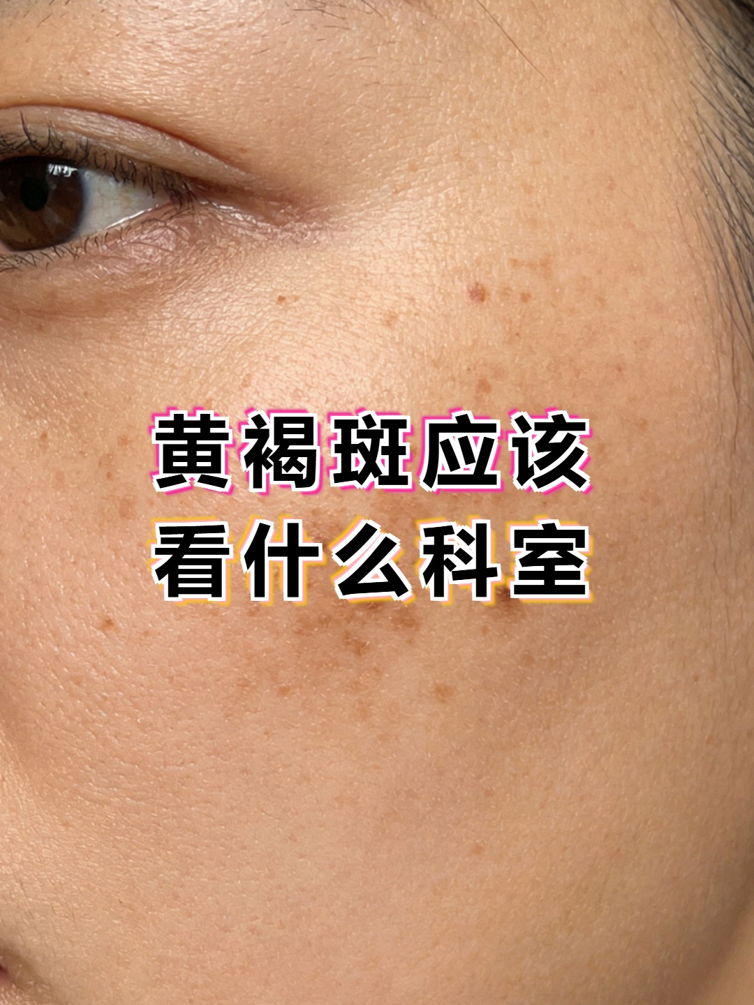 脸上长黄褐斑看什么科最好(脸上长黄褐斑看什么科最好呢) 脸上长黄褐斑看什么科最好(脸上长黄褐斑看什么科最好呢)