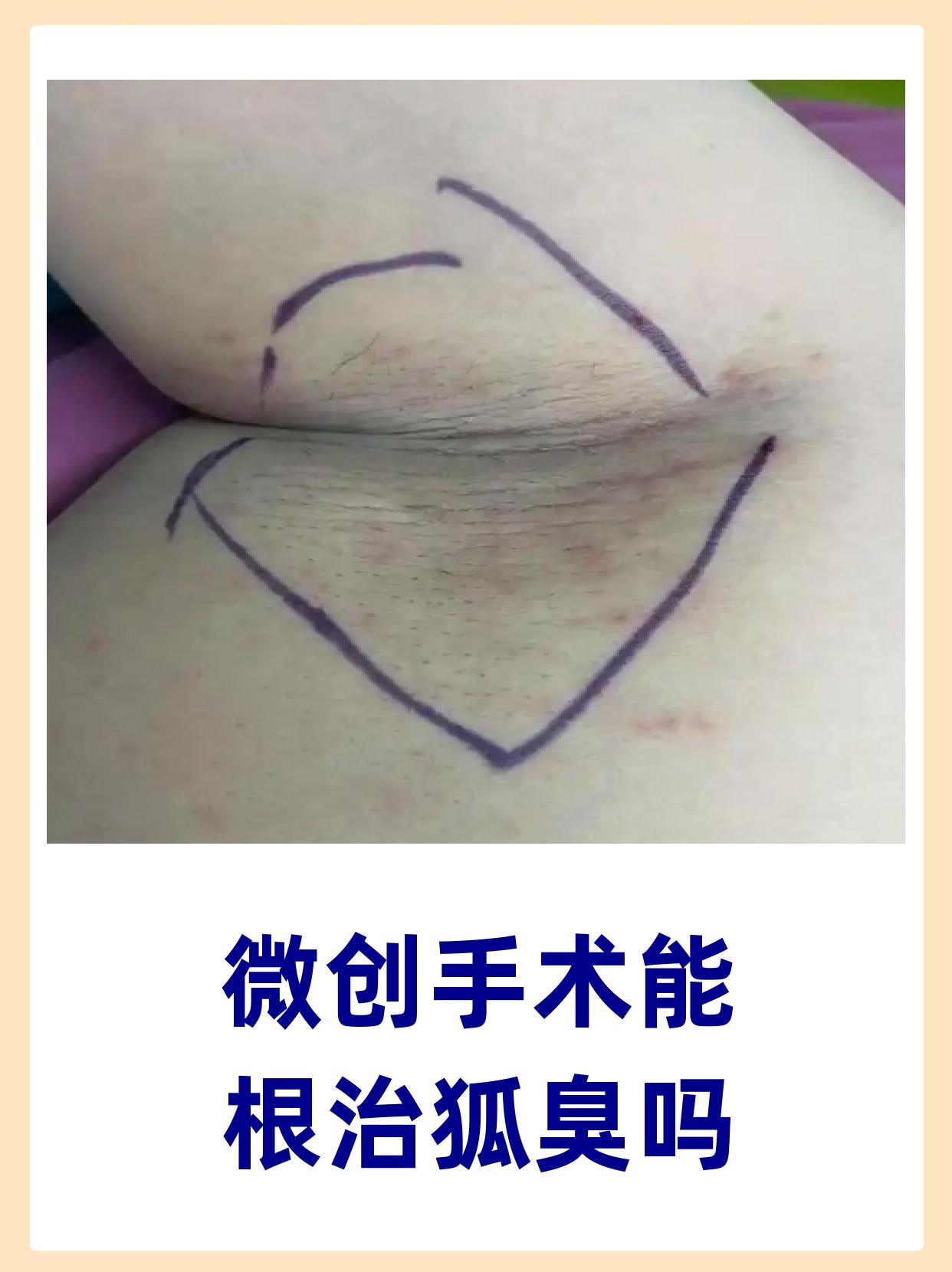 狐臭手术可以永久除根吗(狐臭手术可以永久除根吗会复发吗)
