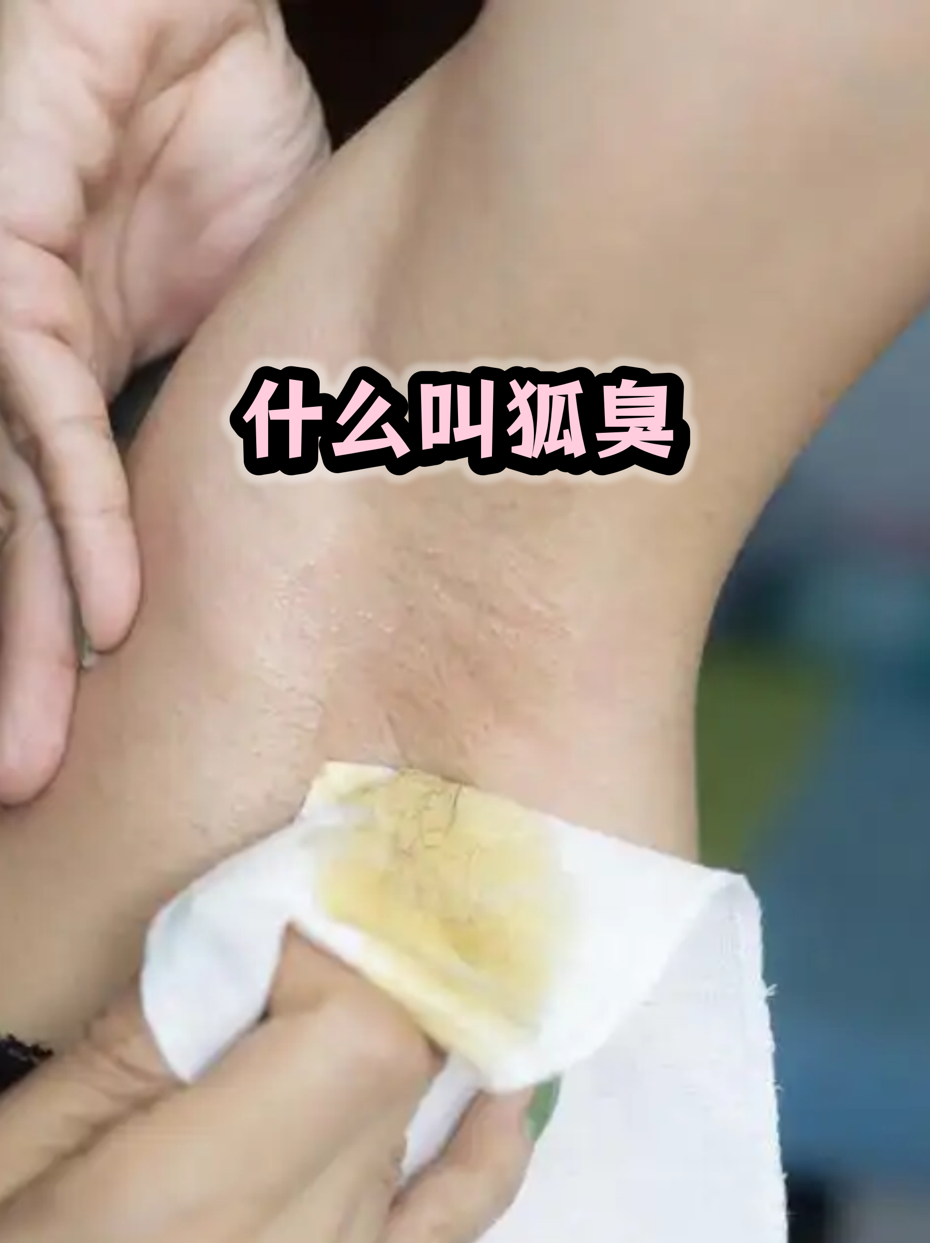 狐臭和正常人腋窝图片原理图(狐臭和正常人腋窝图片原理图对比) 狐臭和正常人腋窝图片原理图(狐臭和正常人腋窝图片原理图对比)