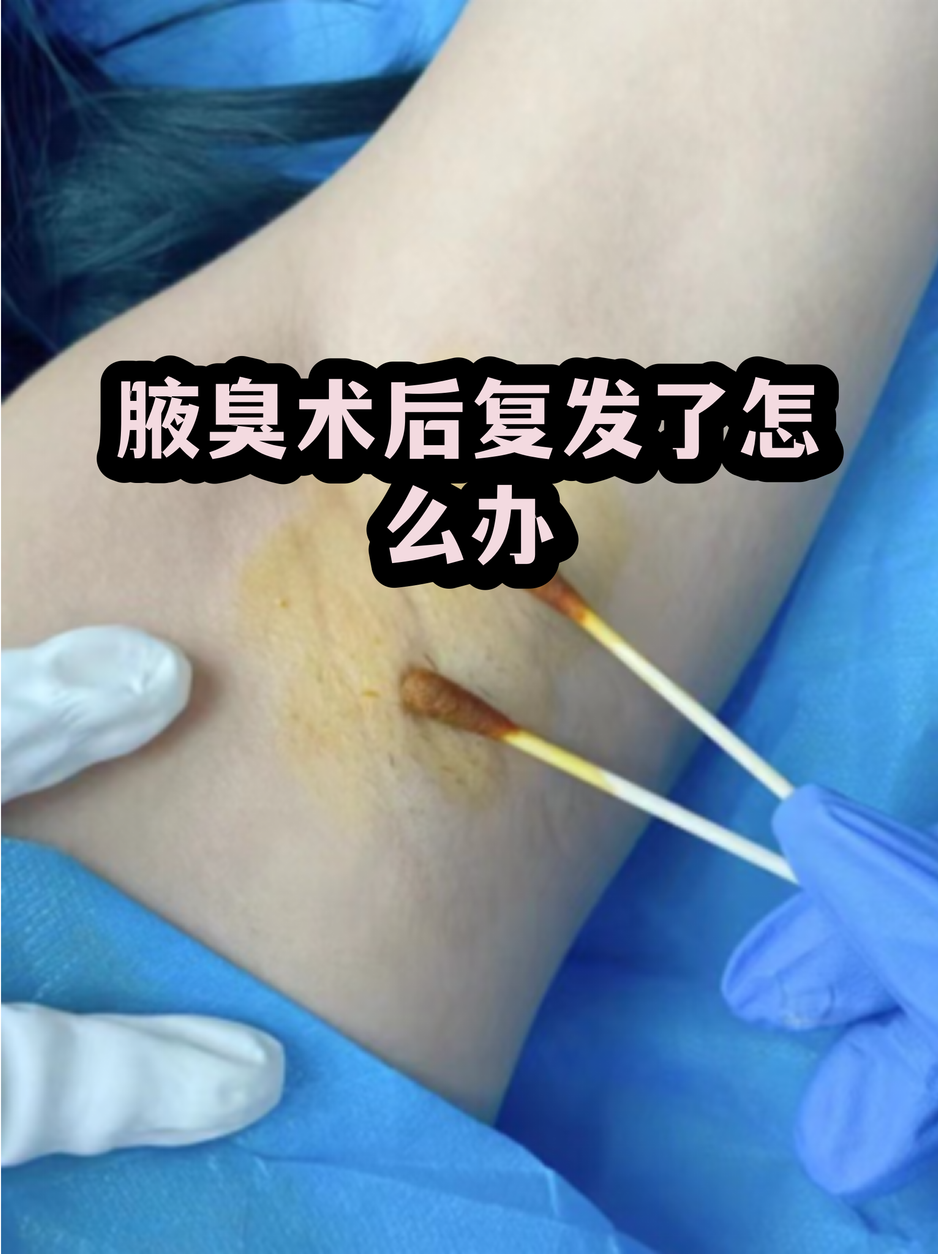 狐臭不手术要怎么处理(狐臭不手术可以根治吗)