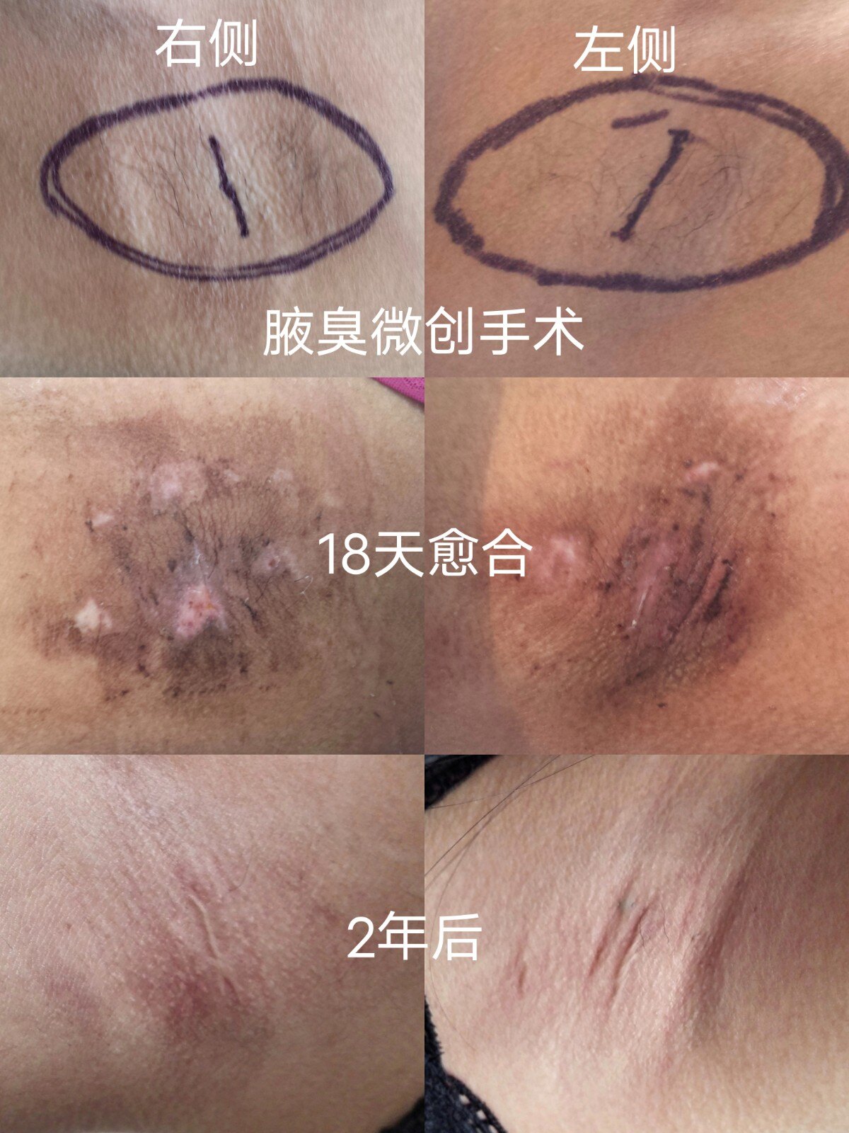 腋臭做了手术又复发了怎么办(腋臭手术做了一个月就复发了正常吗) 腋臭做了手术又复发了怎么办(腋臭手术做了一个月就复发了正常吗)