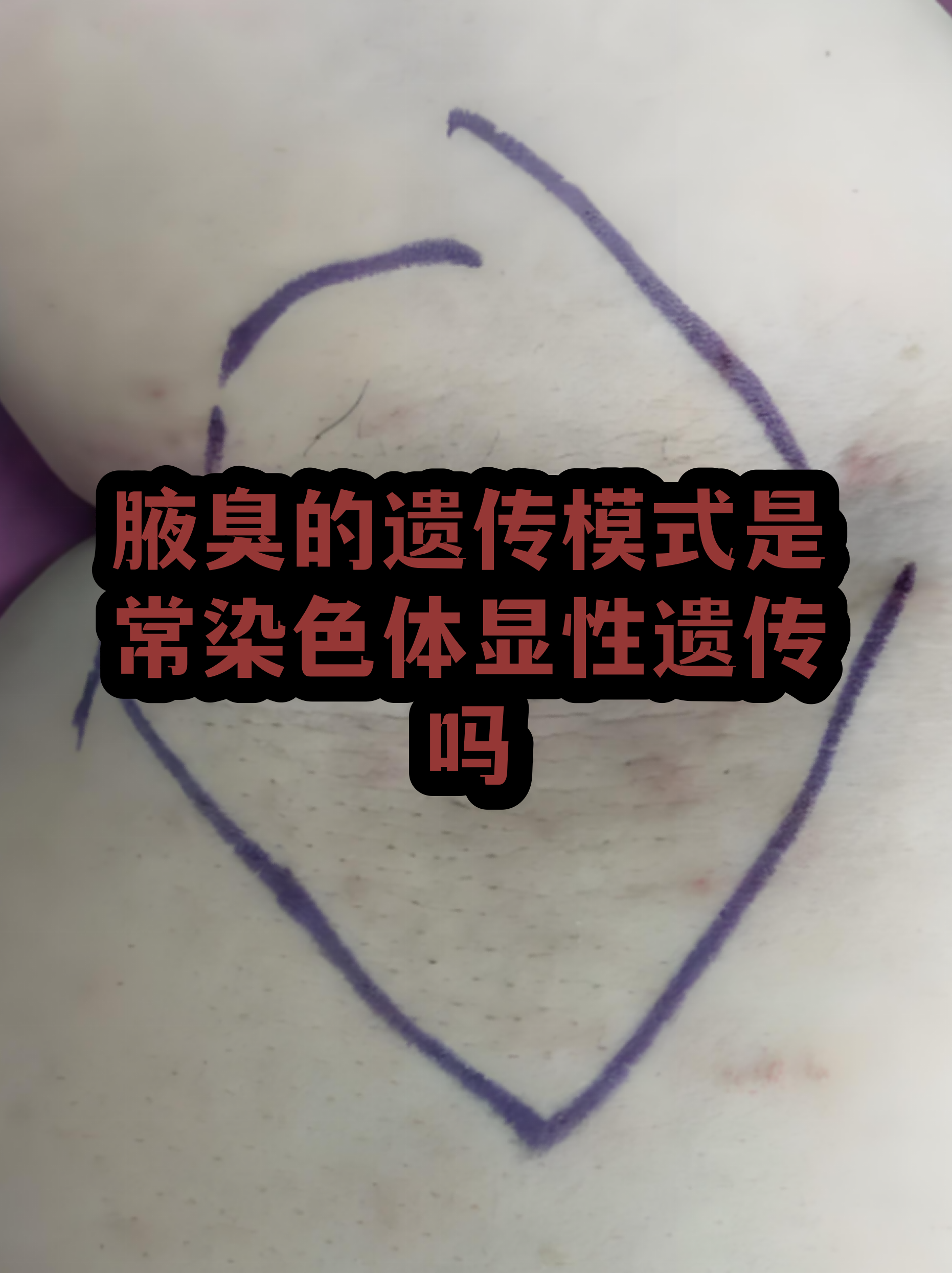 狐臭一般遗传几代人狐臭挂哪个科的简单介绍