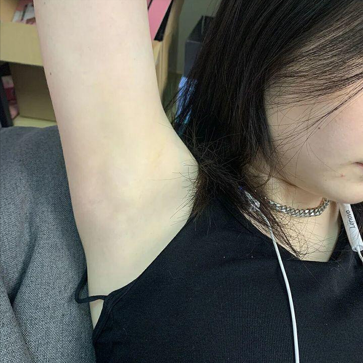 狐臭腋下照片展示(狐臭腋下有什么特征图) 狐臭腋下照片展示(狐臭腋下有什么特征图)