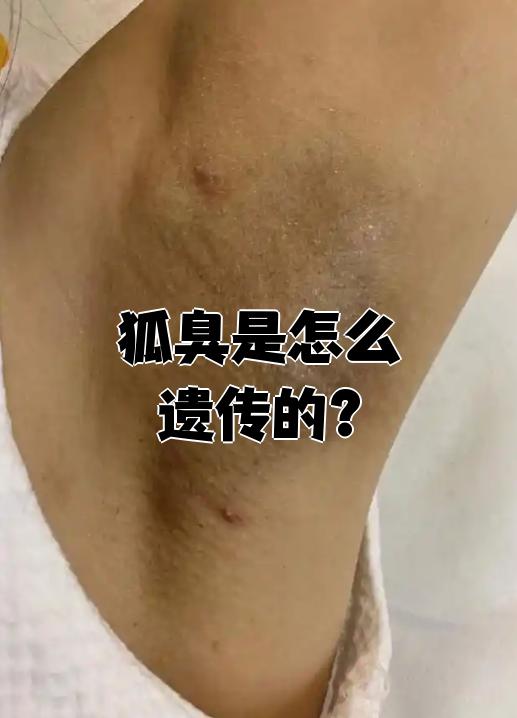 狐臭的女孩子会遗传吗(女的狐臭遗传给男孩多还是女孩多) 狐臭的女孩子会遗传吗(女的狐臭遗传给男孩多还是女孩多)