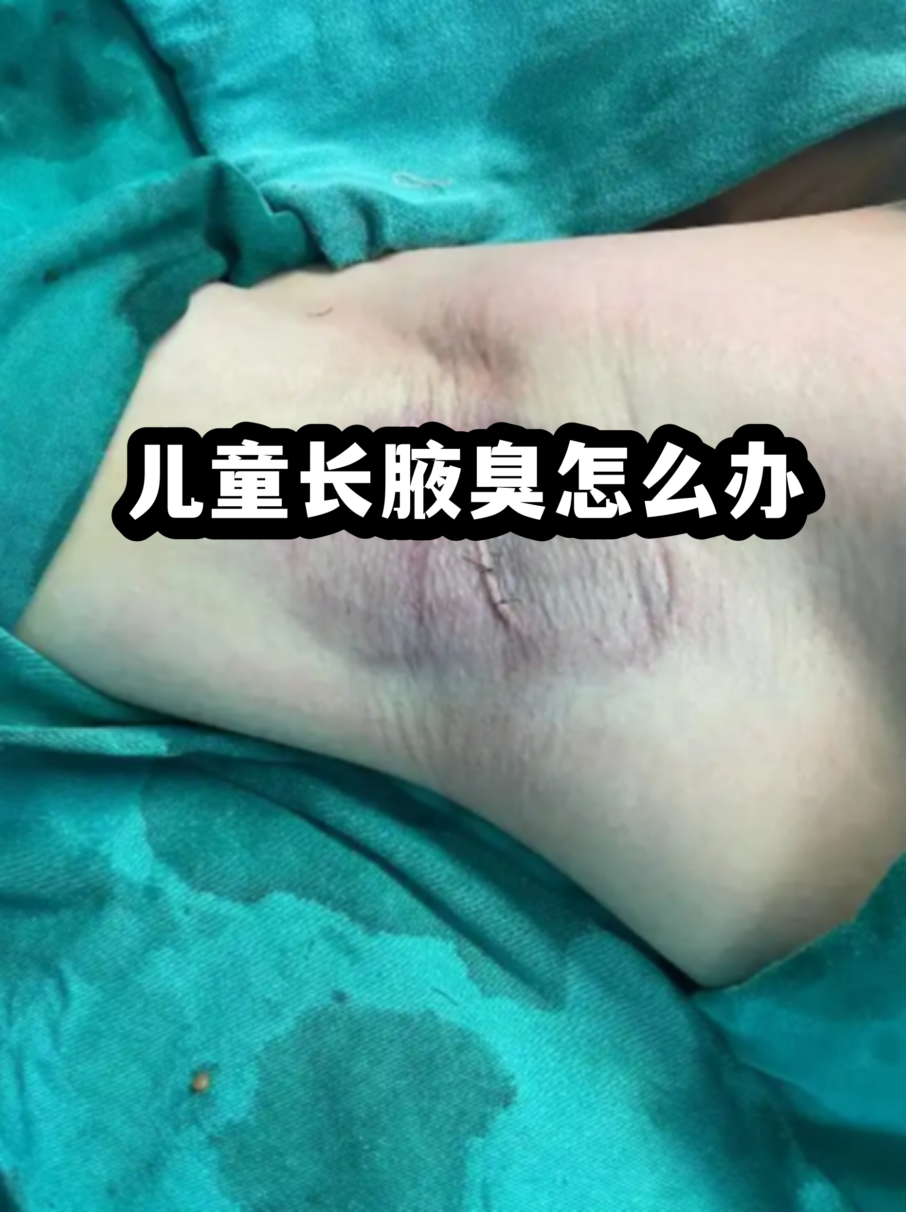 遗传性狐臭一般几岁开始表现出来(遗传性狐臭一般几岁开始表现出来的)