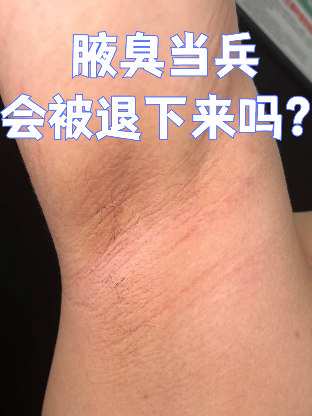 狐臭有影响吗(狐臭会影响大学录取吗) 狐臭有影响吗(狐臭会影响大学录取吗)