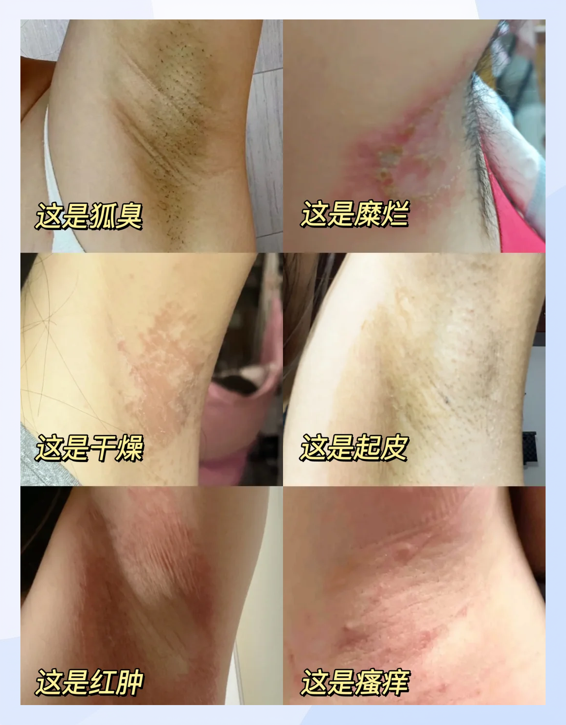 怎样除掉狐臭最有效(怎样才能有效去除狐臭)