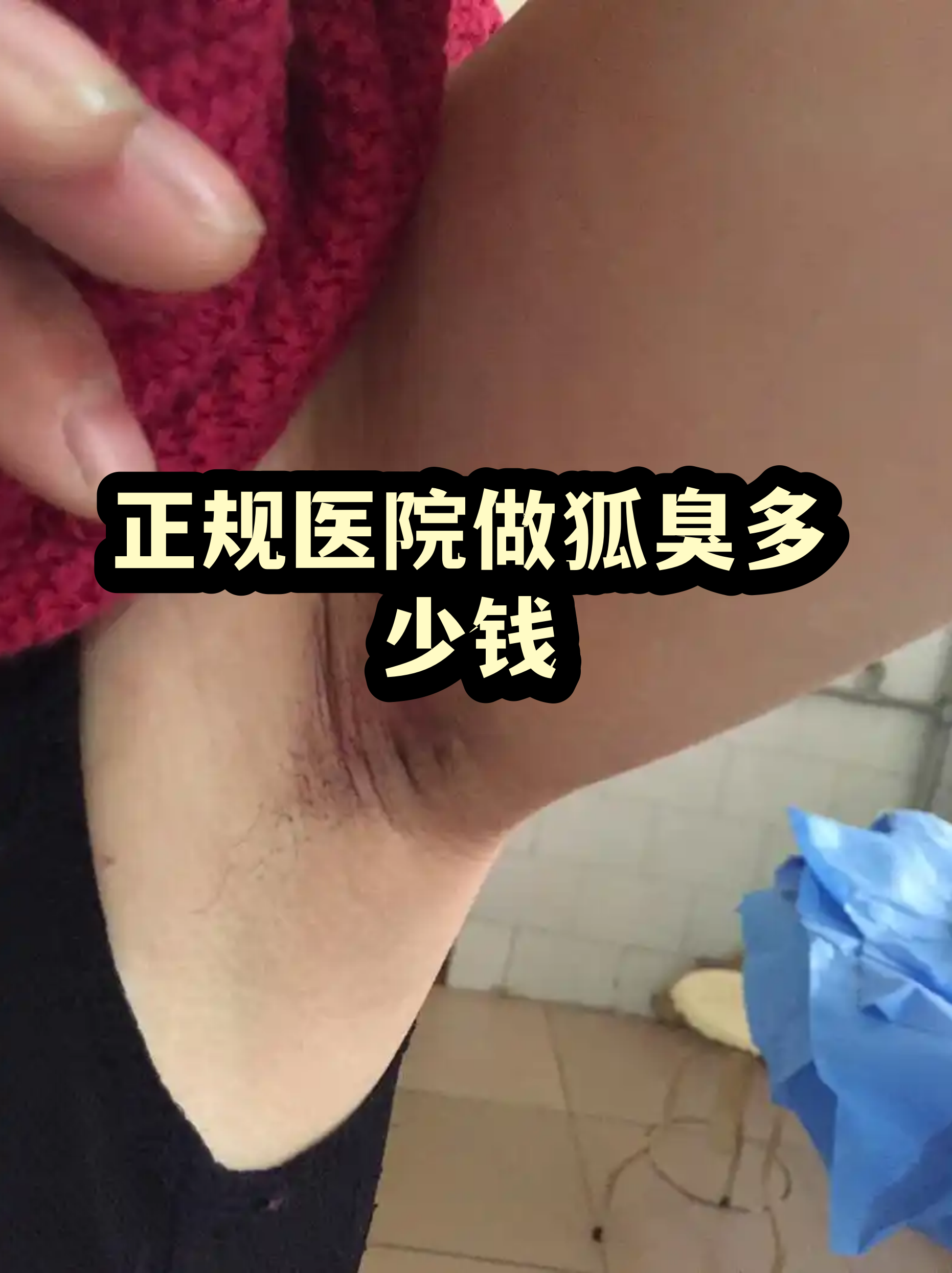 哈尔滨狐臭手术多少钱(割狐臭需要多少钱的手术费哈尔滨松北区)