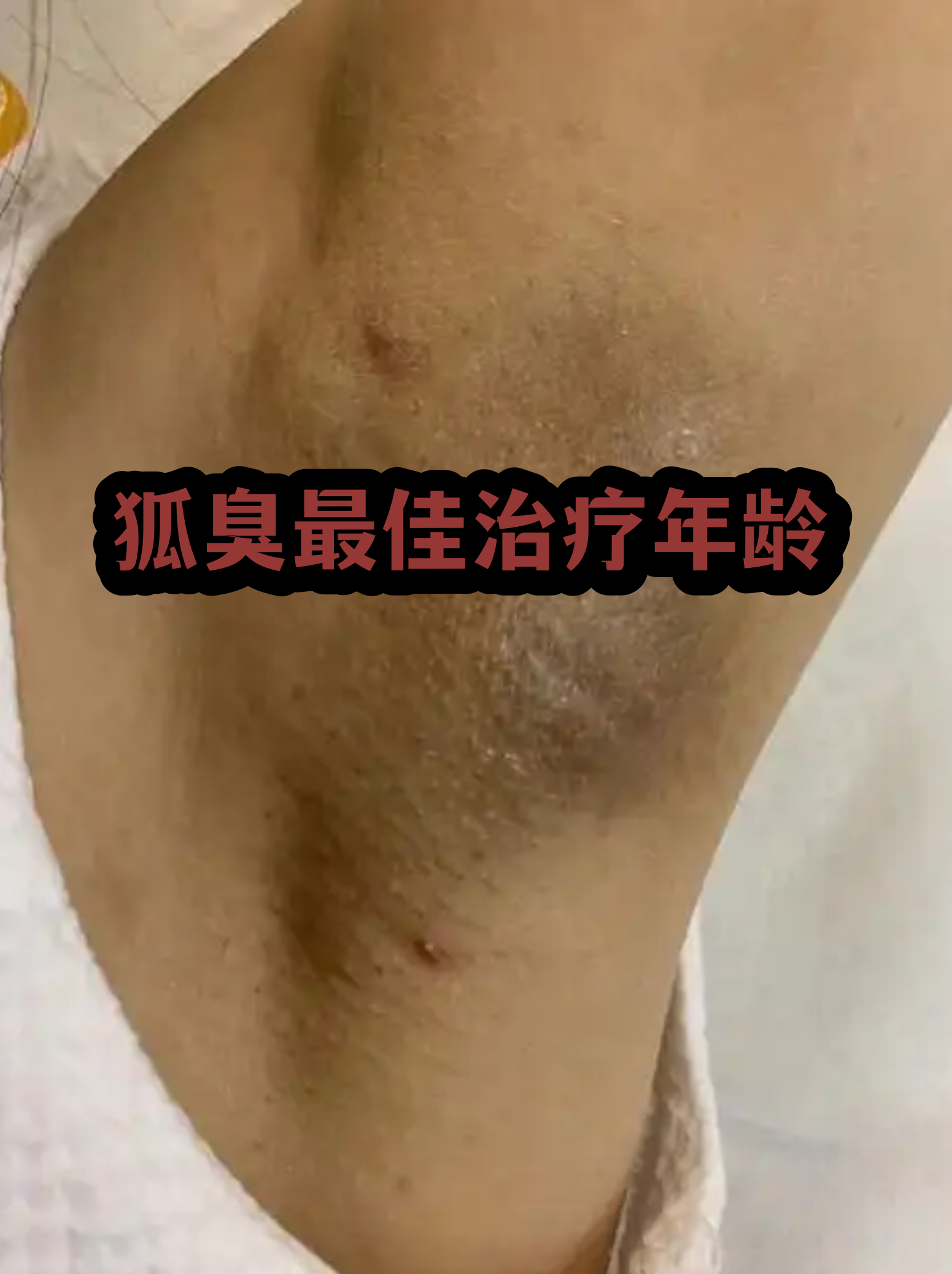 女性狐臭一般什么年龄消失(女性狐臭手术价格一般在多少) 女性狐臭一般什么年龄消失(女性狐臭手术价格一般在多少)