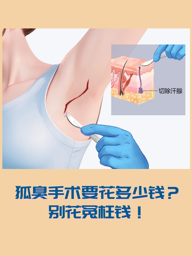 狐臭的手术费用一般是多少(狐臭手术一般多少钱正规医院)