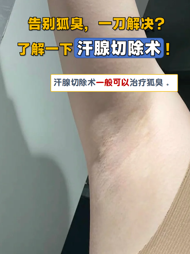 狐臭人的腋窝是什么样(狐臭的腋窝和正常人有区别吗)