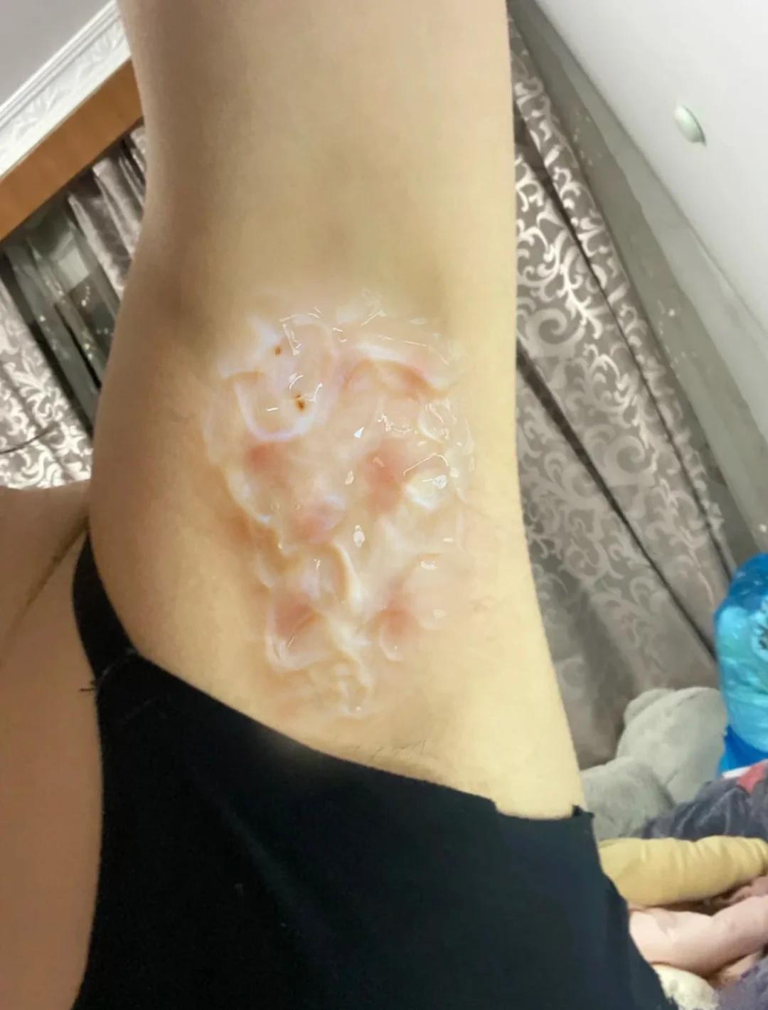 青春期假性狐臭会自愈吗(青春期假性狐臭会自愈吗多久)