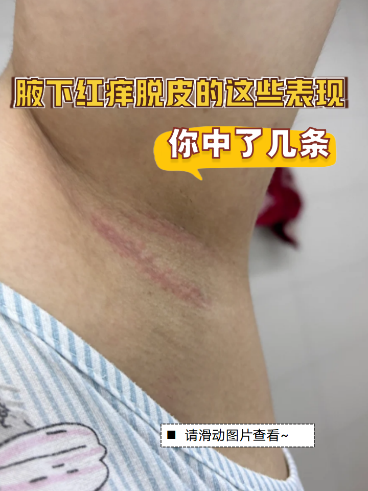 青春期假性狐臭的症状(青春期假性狐臭和狐臭的区别) 青春期假性狐臭的症状(青春期假性狐臭和狐臭的区别)