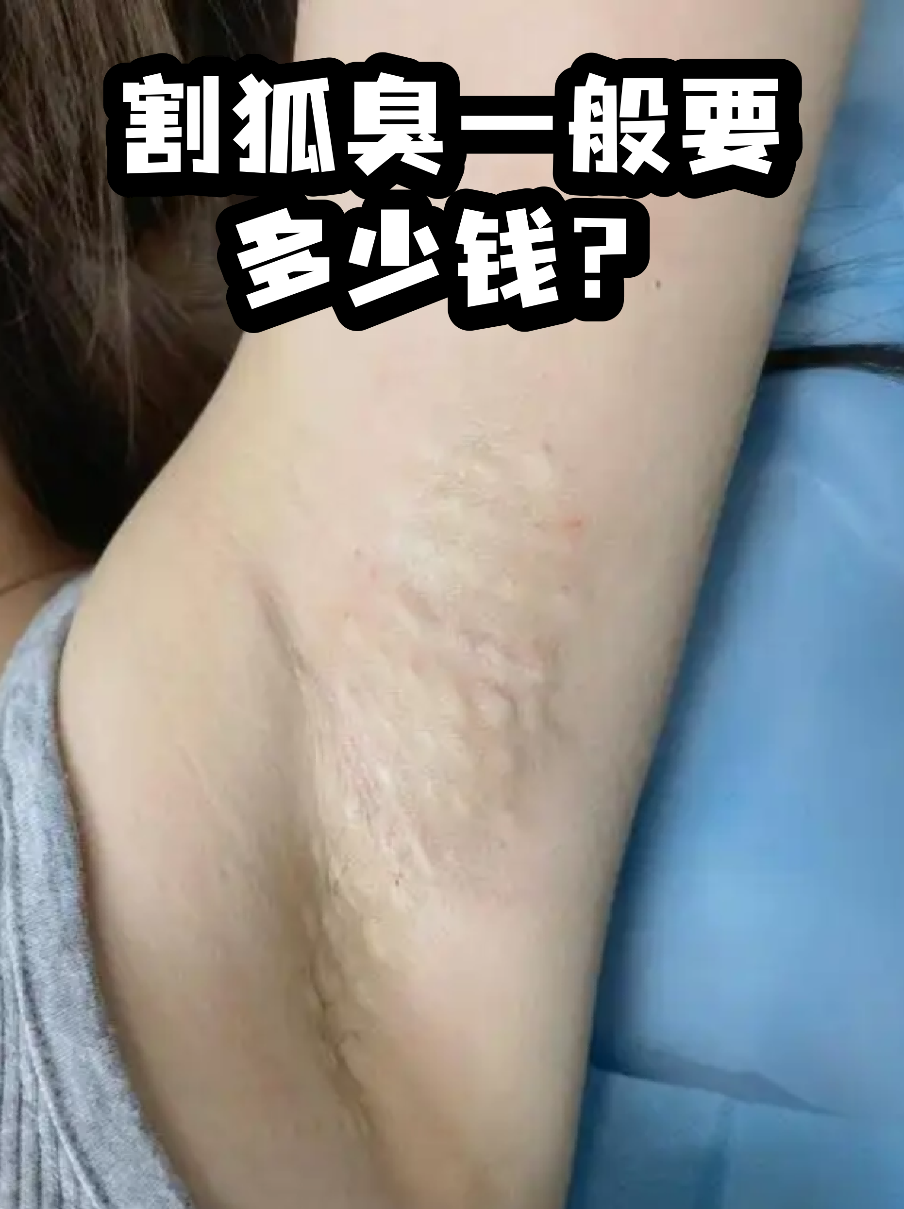 狐臭手术一般费用多少可以报销吗(狐臭手术一般费用多少可以报销吗?) 狐臭手术一般费用多少可以报销吗(狐臭手术一般费用多少可以报销吗?)
