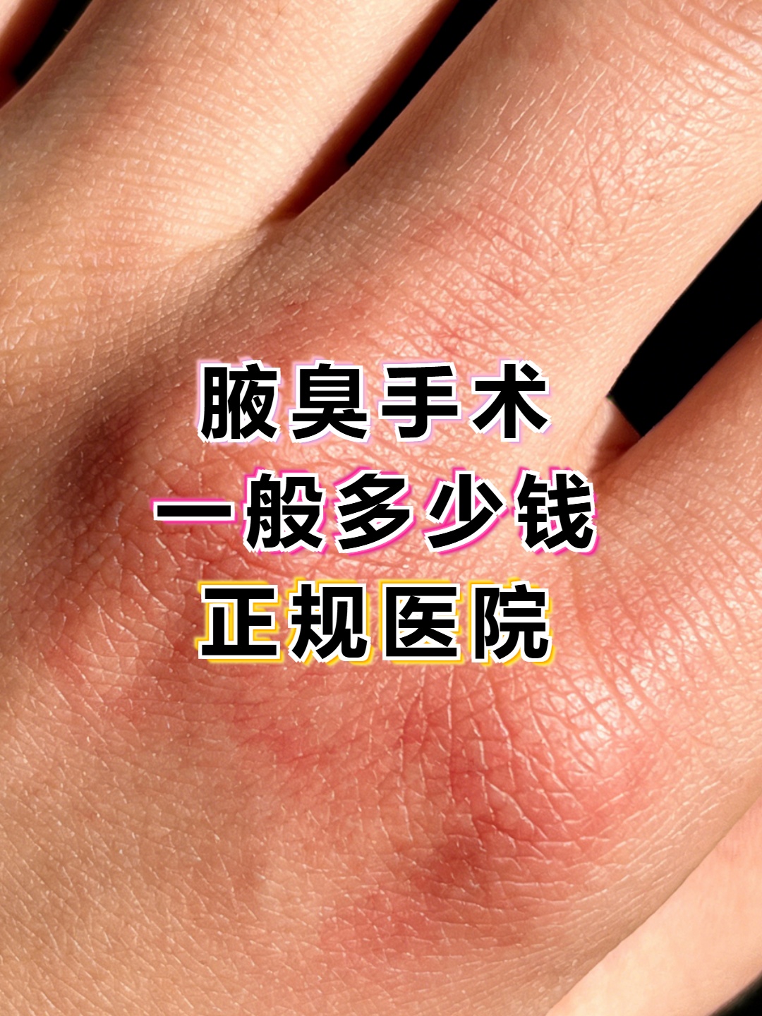 狐臭手术可以报销医保吗(狐臭手术可以报销医保吗?)