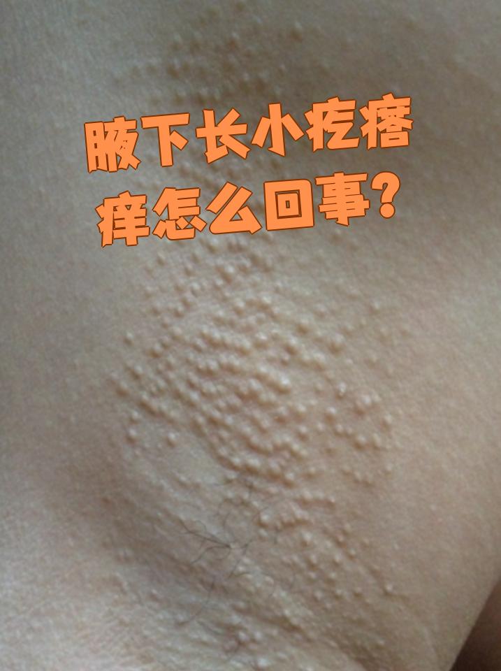 狐臭的人腋下有疙瘩吗(有狐臭的人腋下一定有味道吗)