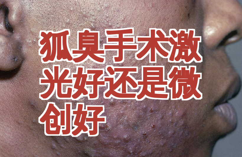 狐臭微创和激光哪个好不留疤痕(狐臭微创和激光哪个好不留疤痕呢)