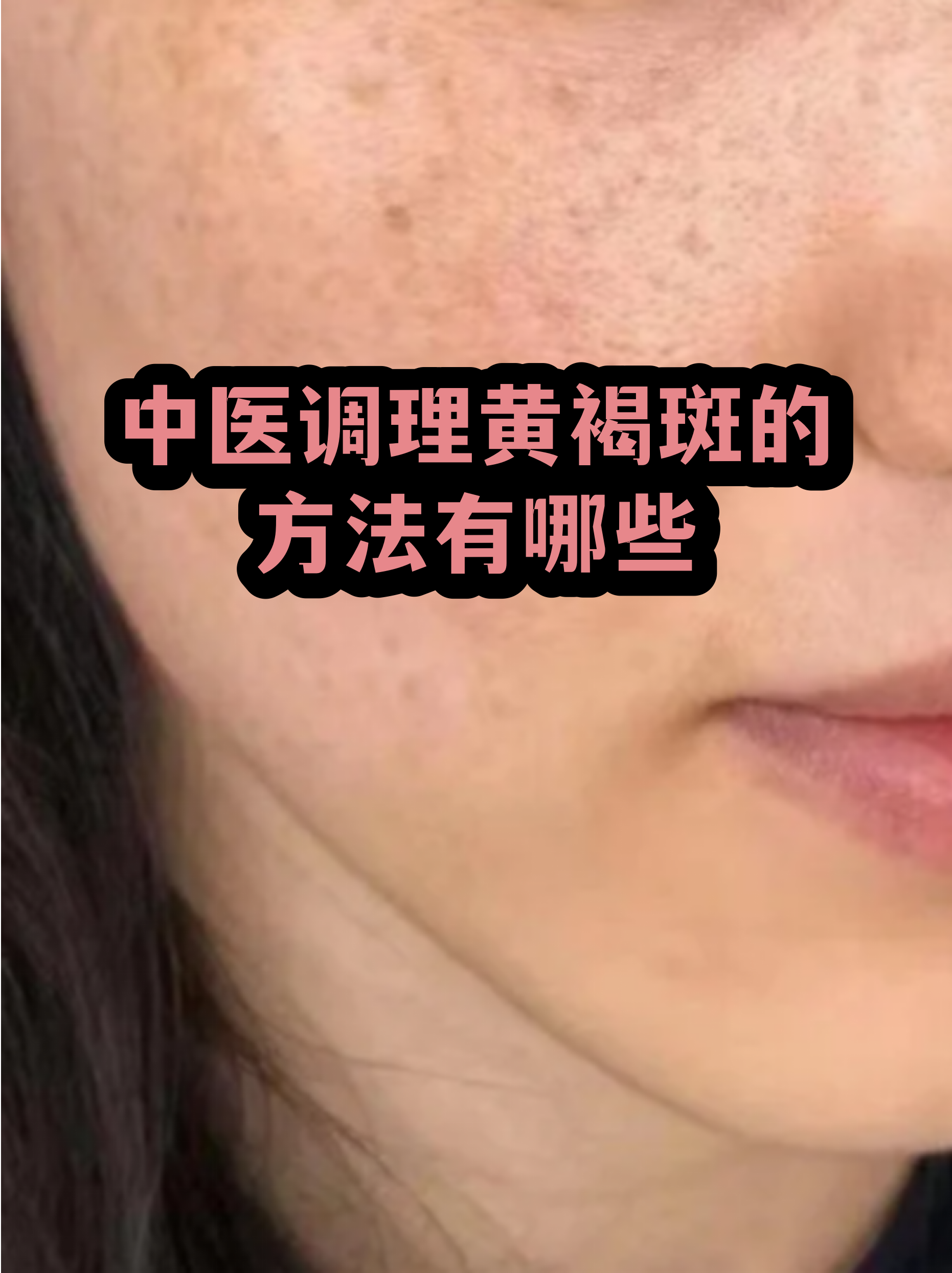 脸上长黄褐斑看什么科(脸上长黄褐斑看什么科一)