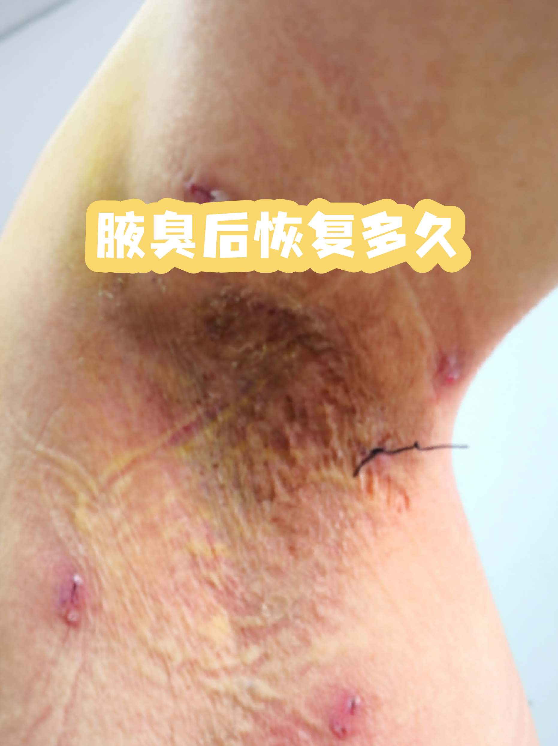 狐臭什么时候能发现(狐臭什么时候开始出现) 狐臭什么时候能发现(狐臭什么时候开始出现)